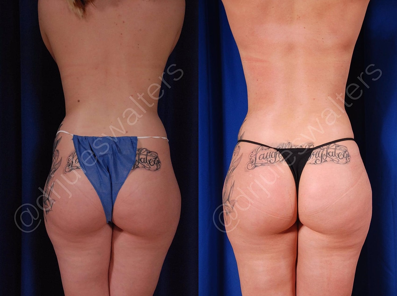 Brazilian Butt Lift Before & After