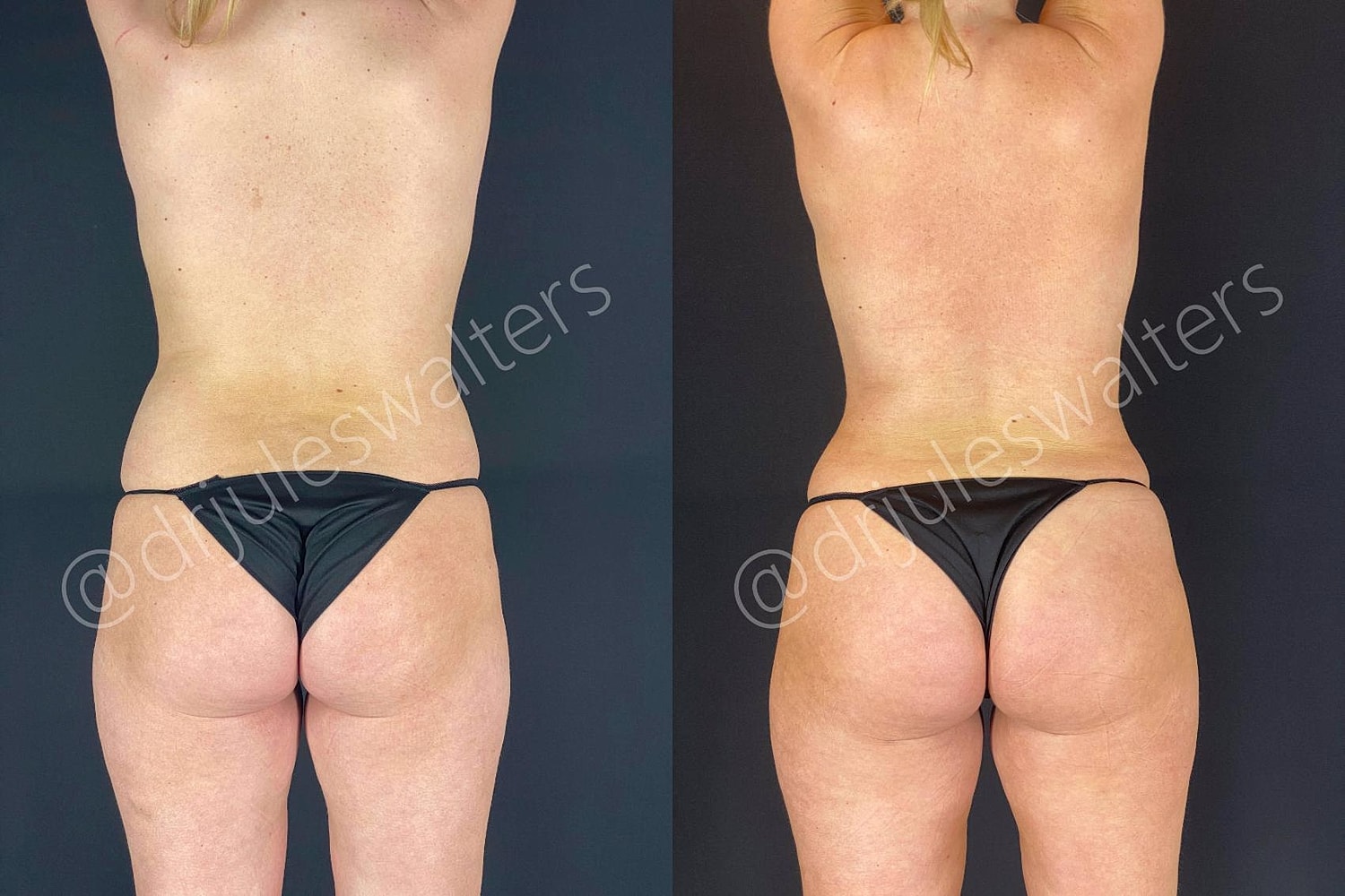 Brazilian Butt Lift Before & After