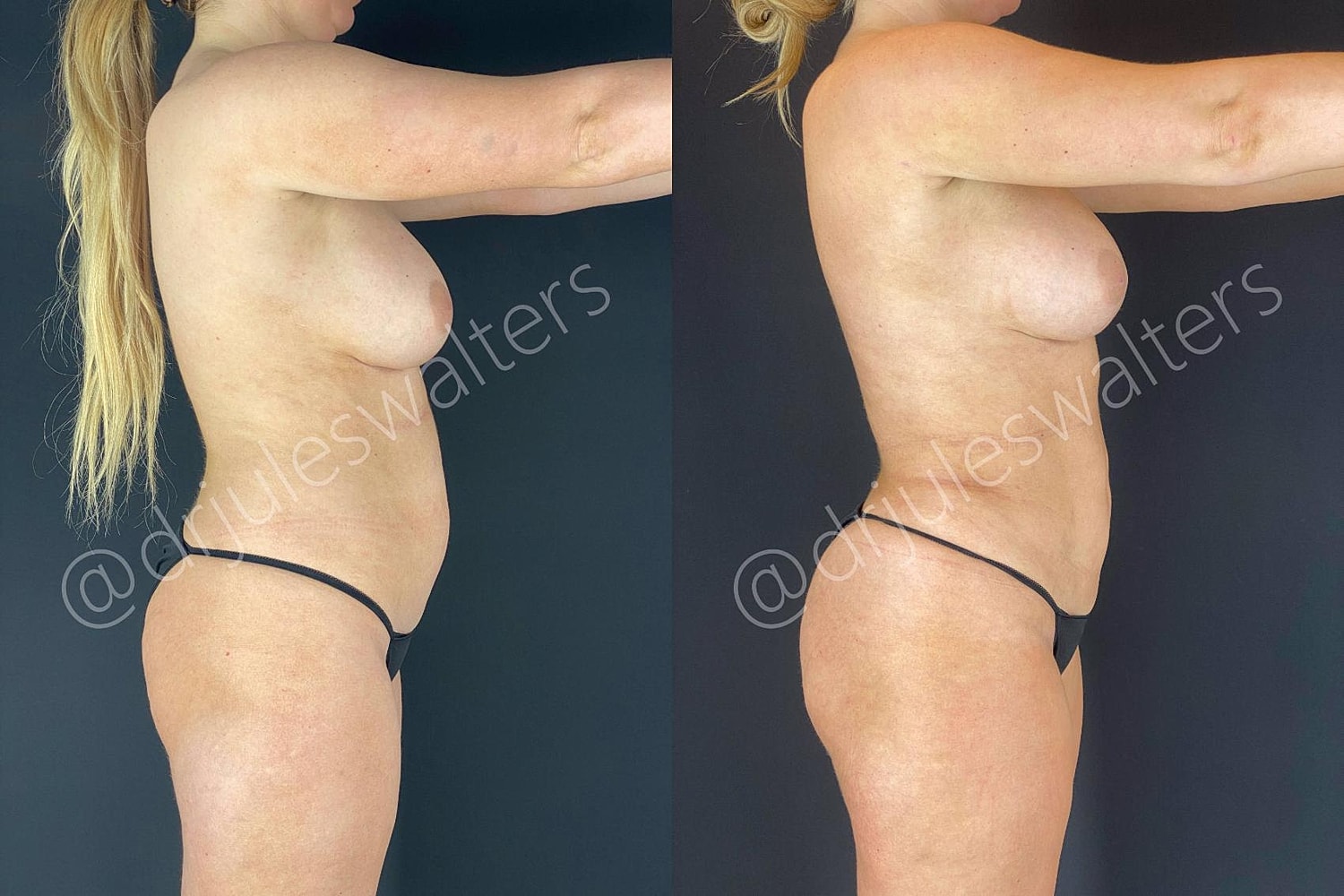 Brazilian Butt Lift Before & After