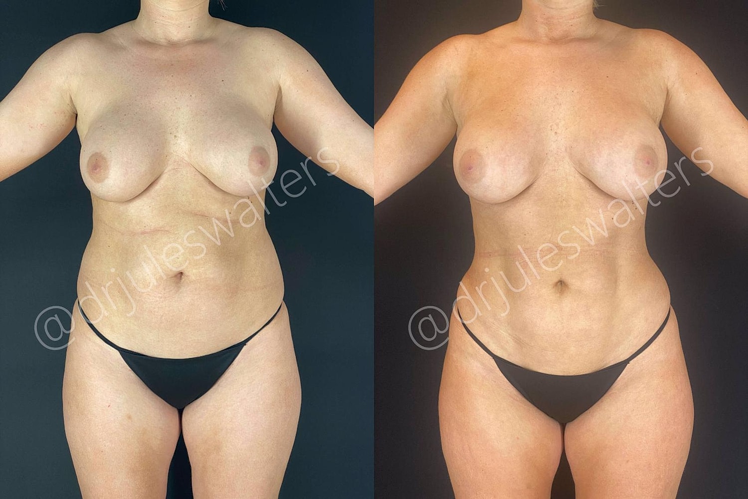 Brazilian Butt Lift Before & After