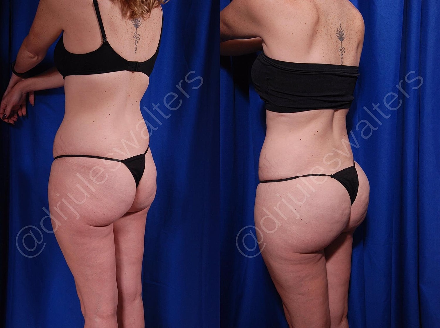 Brazilian Butt Lift Before & After