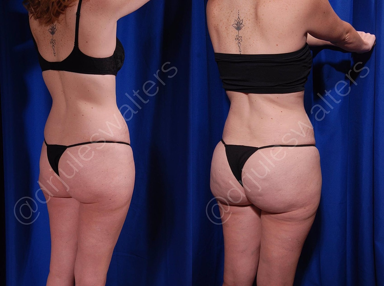 Brazilian Butt Lift Before & After