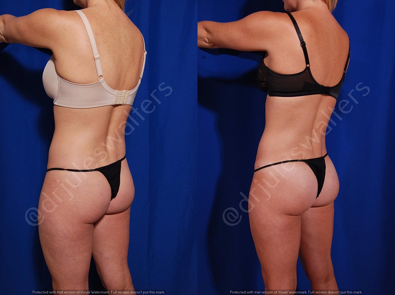 Brazilian Butt Lift Before & After