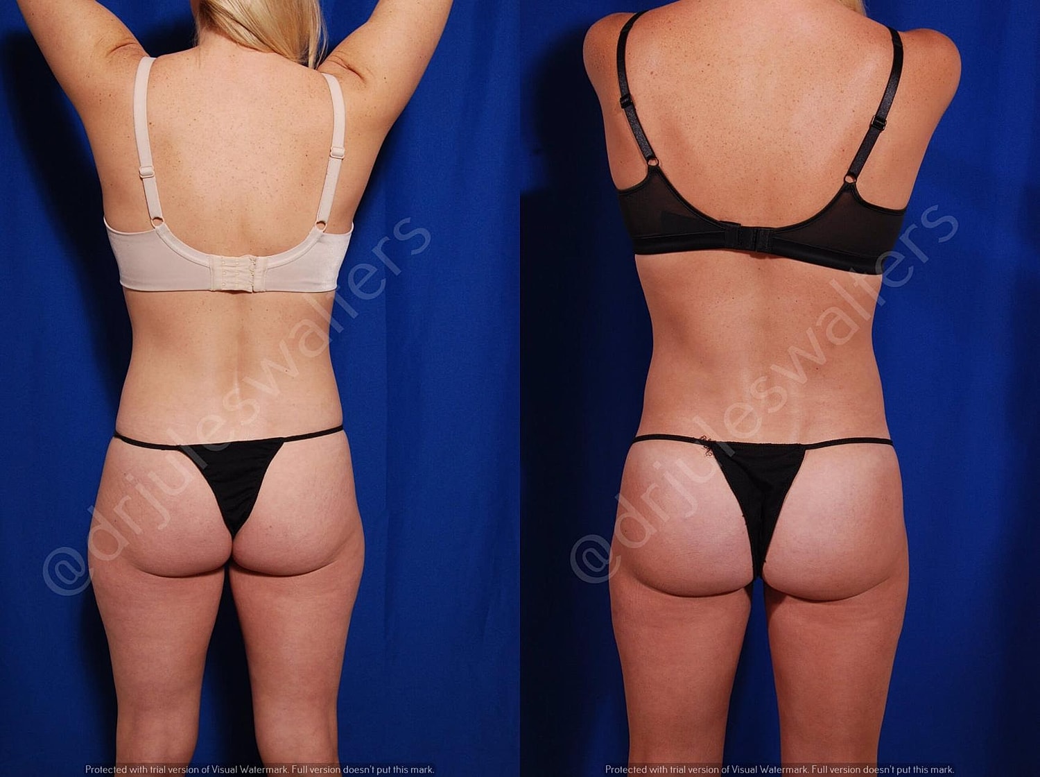 Brazilian Butt Lift Before & After