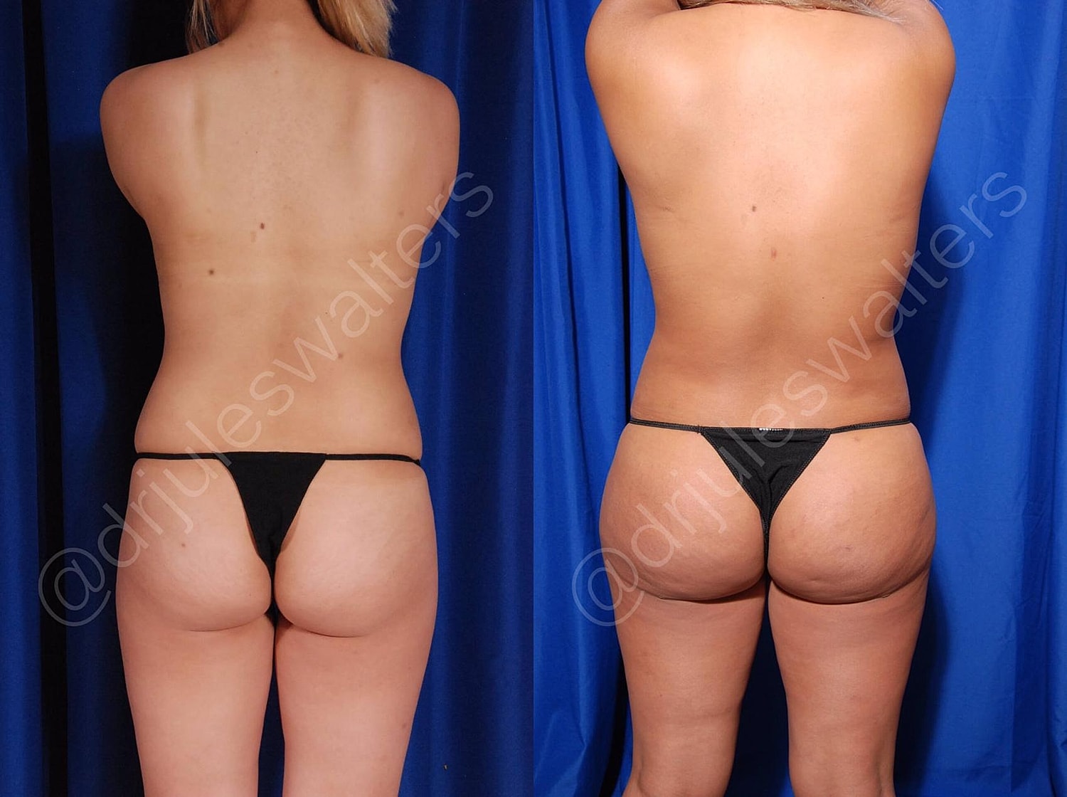 Brazilian Butt Lift Before & After