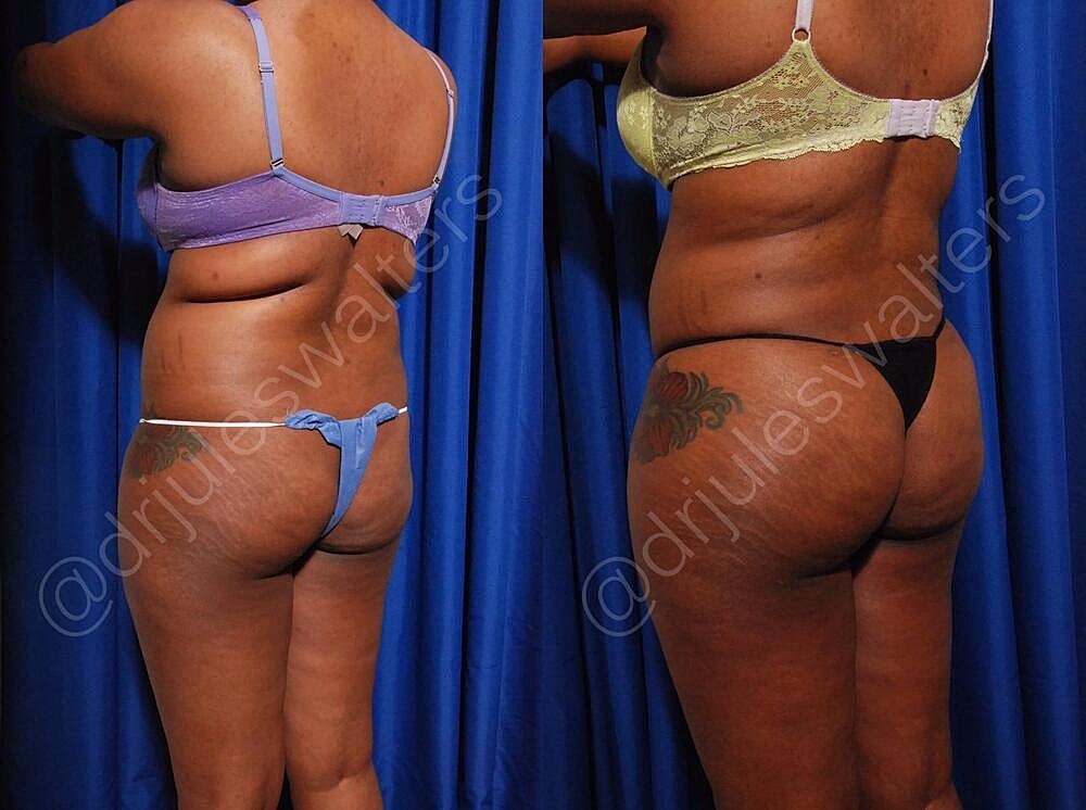 Brazilian Butt Lift Before & After