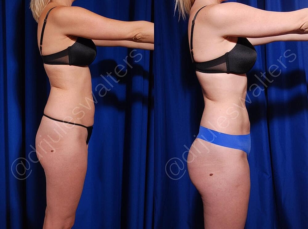 Brazilian Butt Lift Before & After