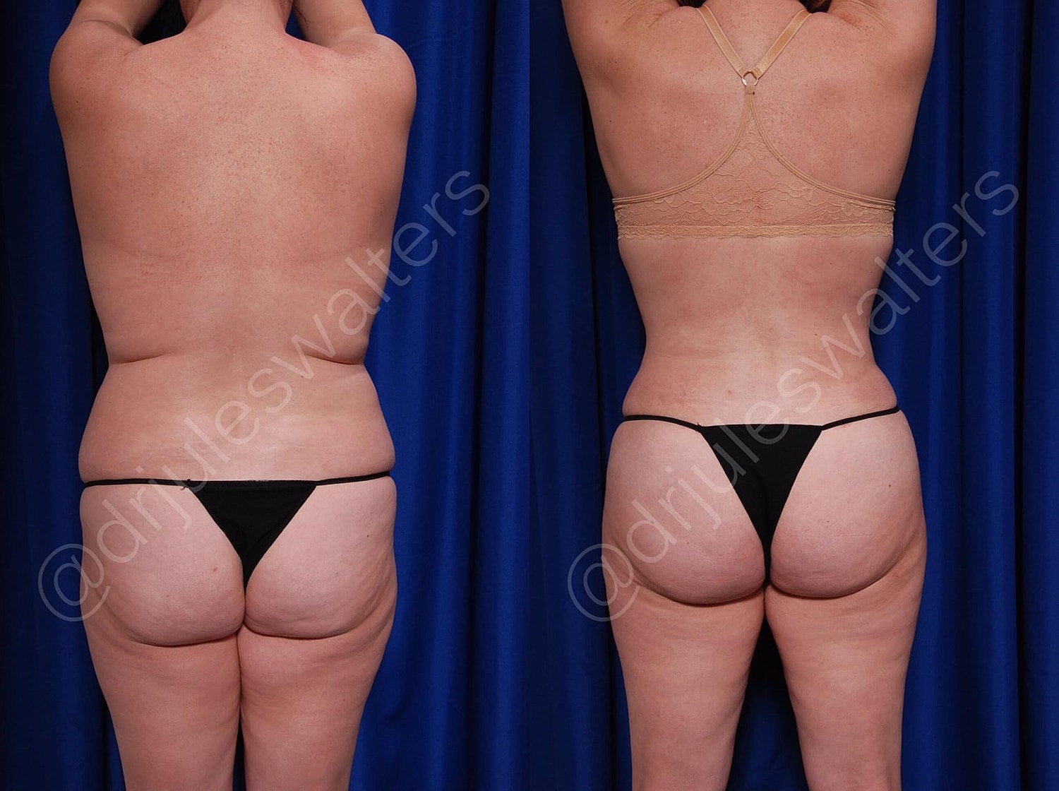 Fat Transfer Before & After