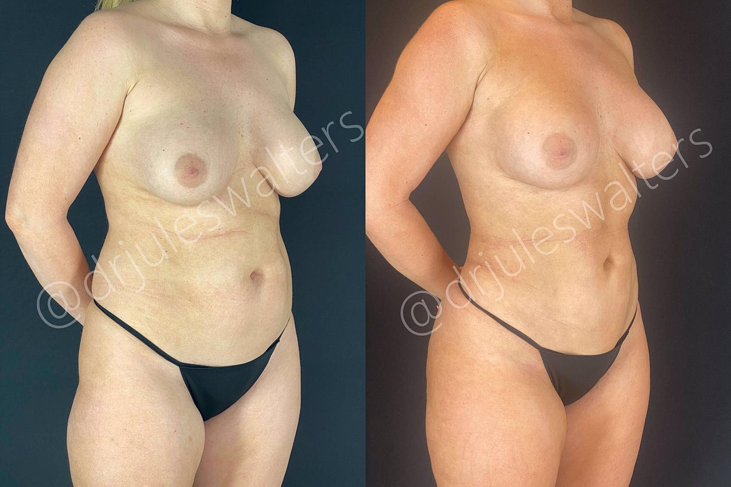 Fat Transfer Before & After