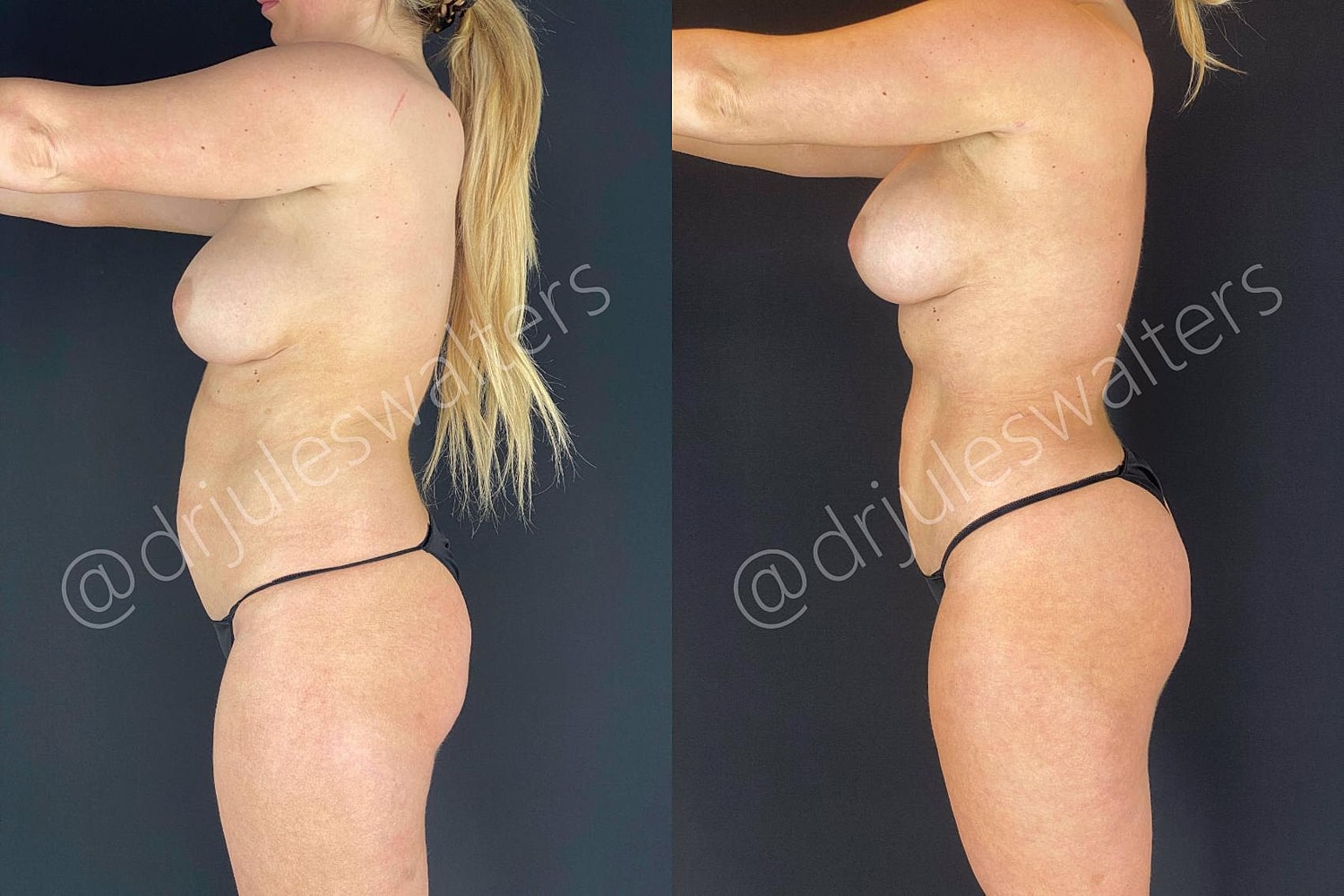 Fat Transfer Before & After