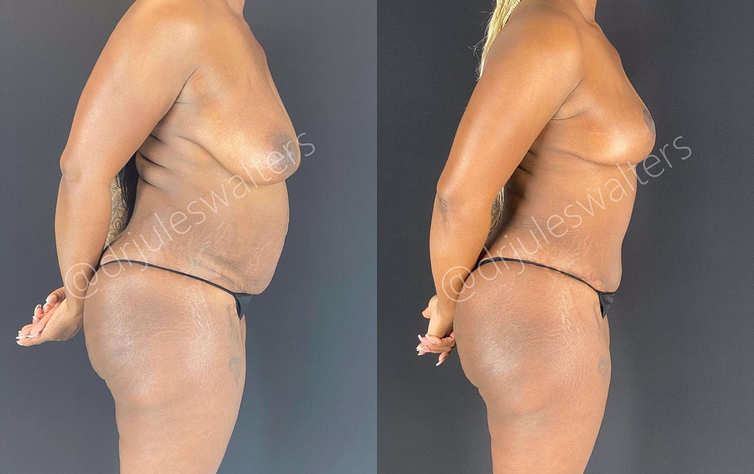 Fat Transfer Before & After