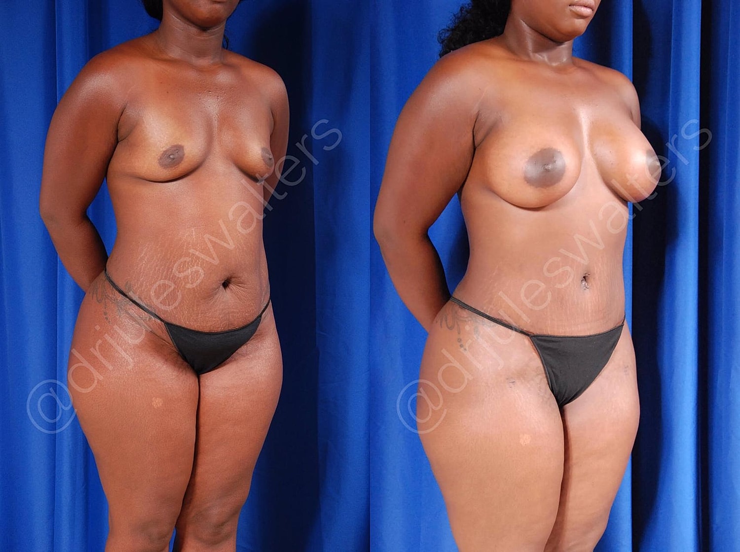 Fat Transfer Before & After