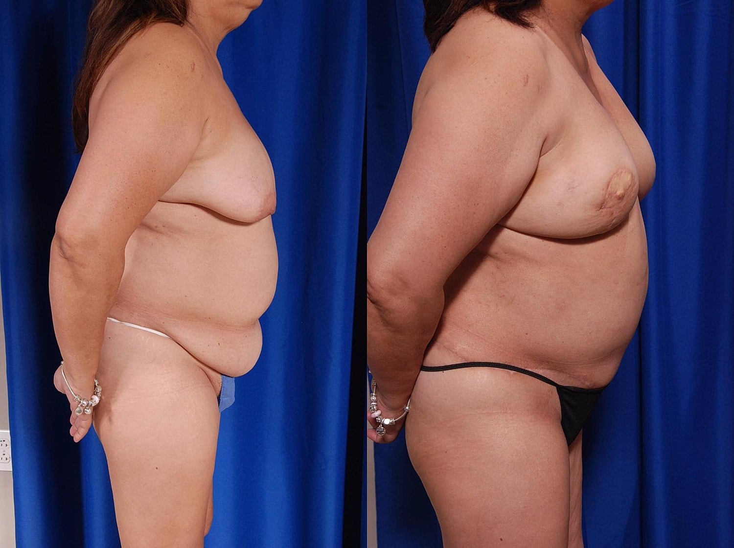 Fat Transfer Before & After