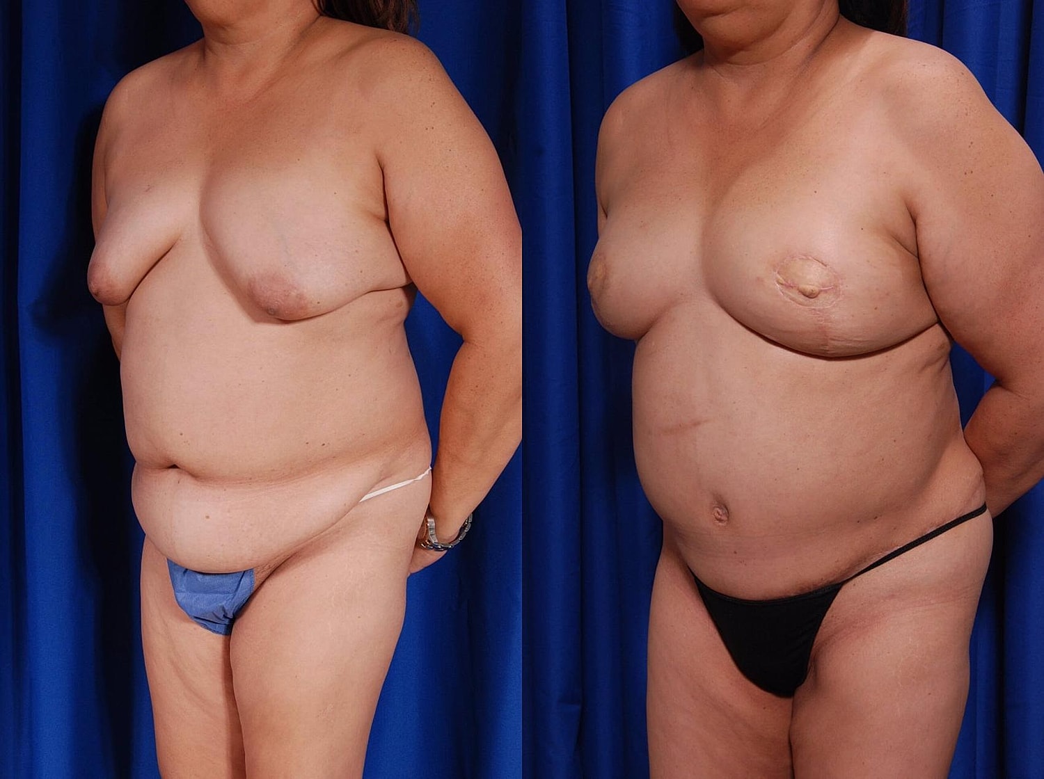 Fat Transfer Before & After