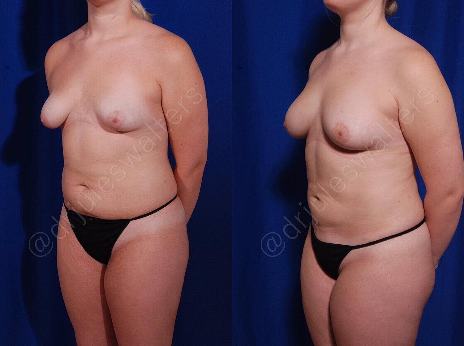Fat Transfer Before & After