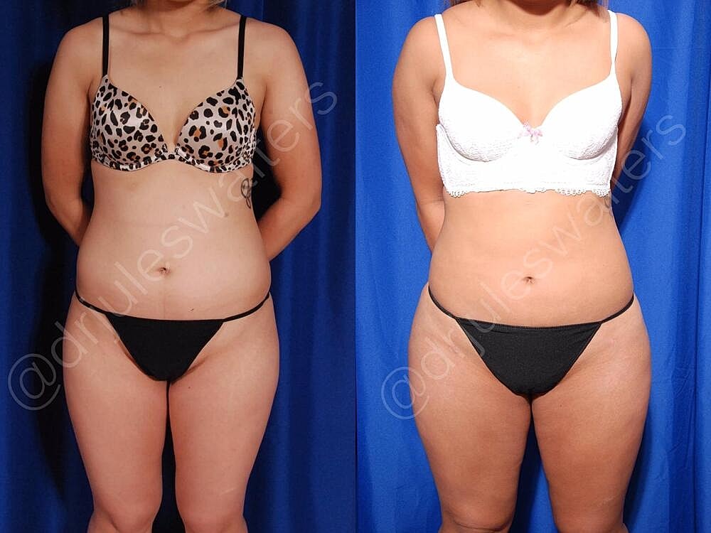 Fat Transfer Before & After