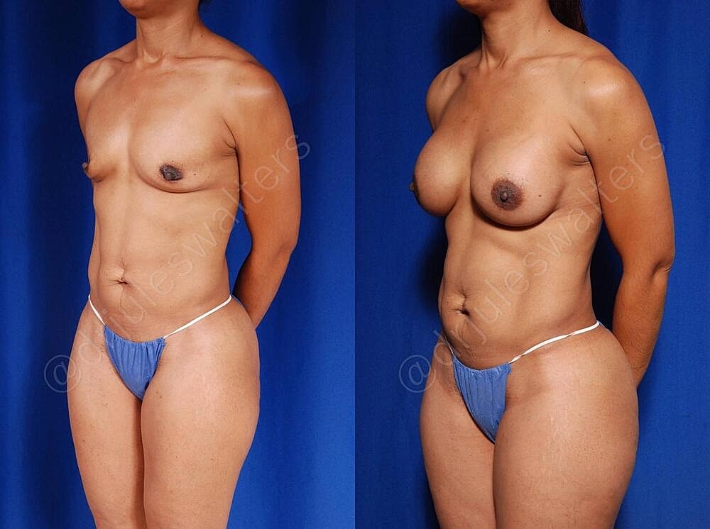 Fat Transfer Before & After