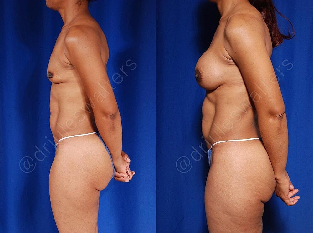 Fat Transfer Before & After