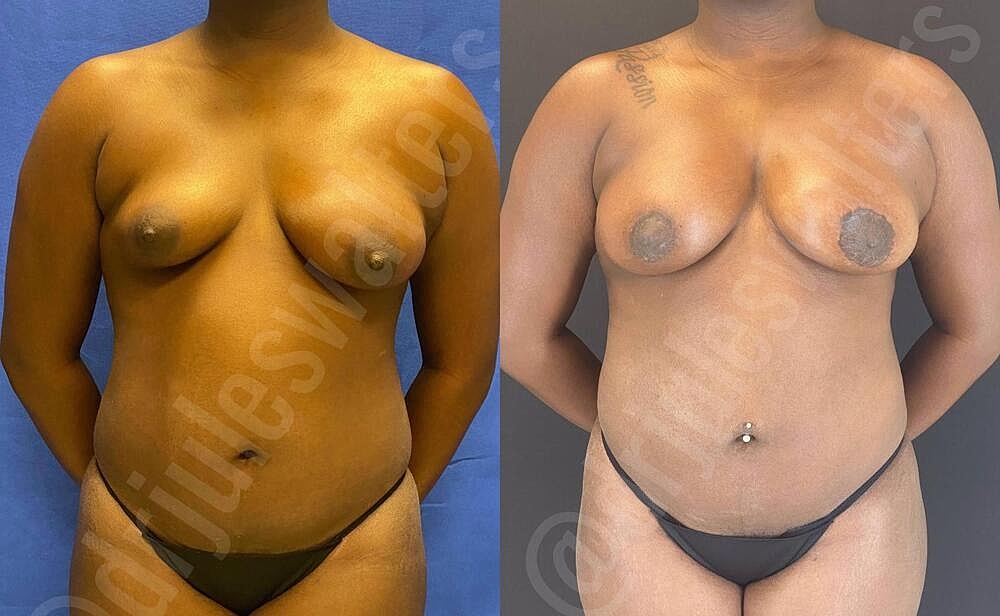 Fat Transfer Before & After
