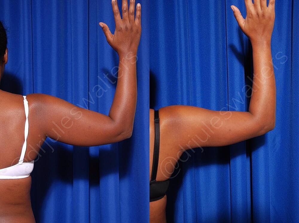 Fat Transfer Before & After