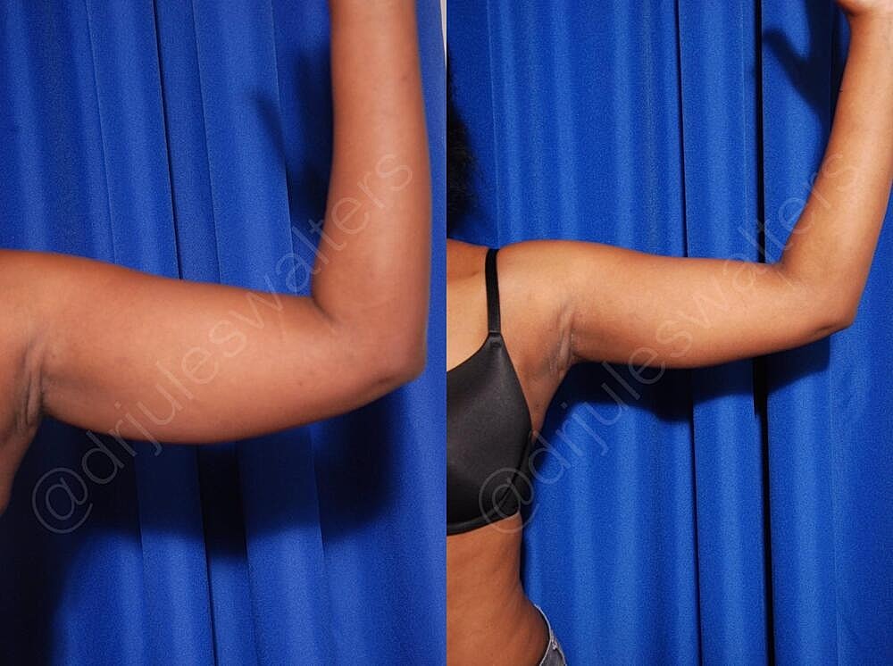 Fat Transfer Before & After