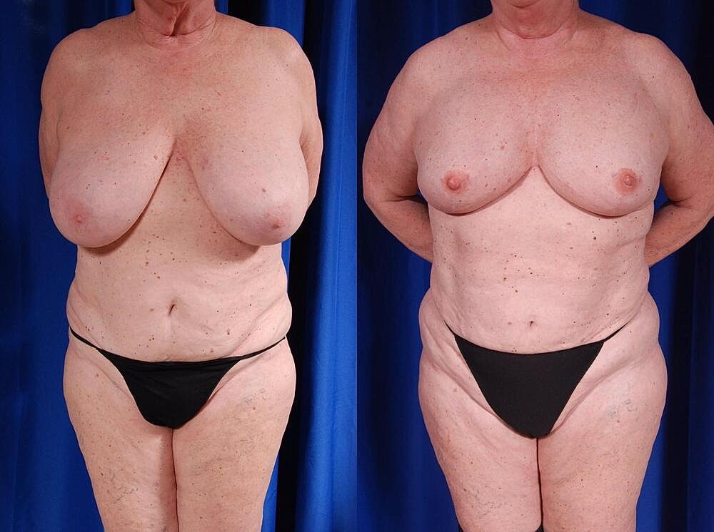 Fat Transfer Before & After