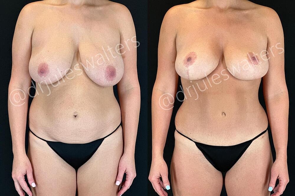 Fat Transfer Before & After