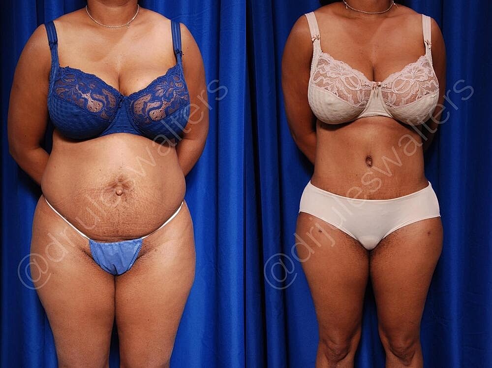 Fat Transfer Before & After