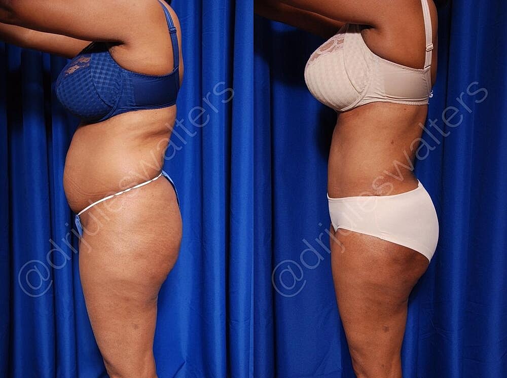 Fat Transfer Before & After