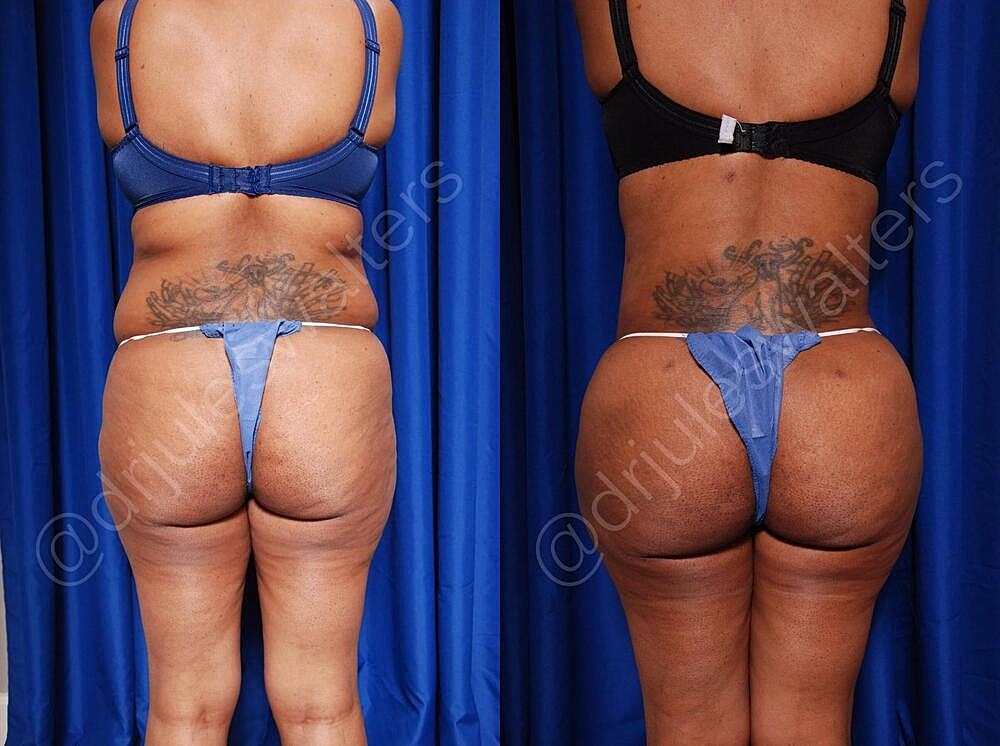 Fat Transfer Before & After
