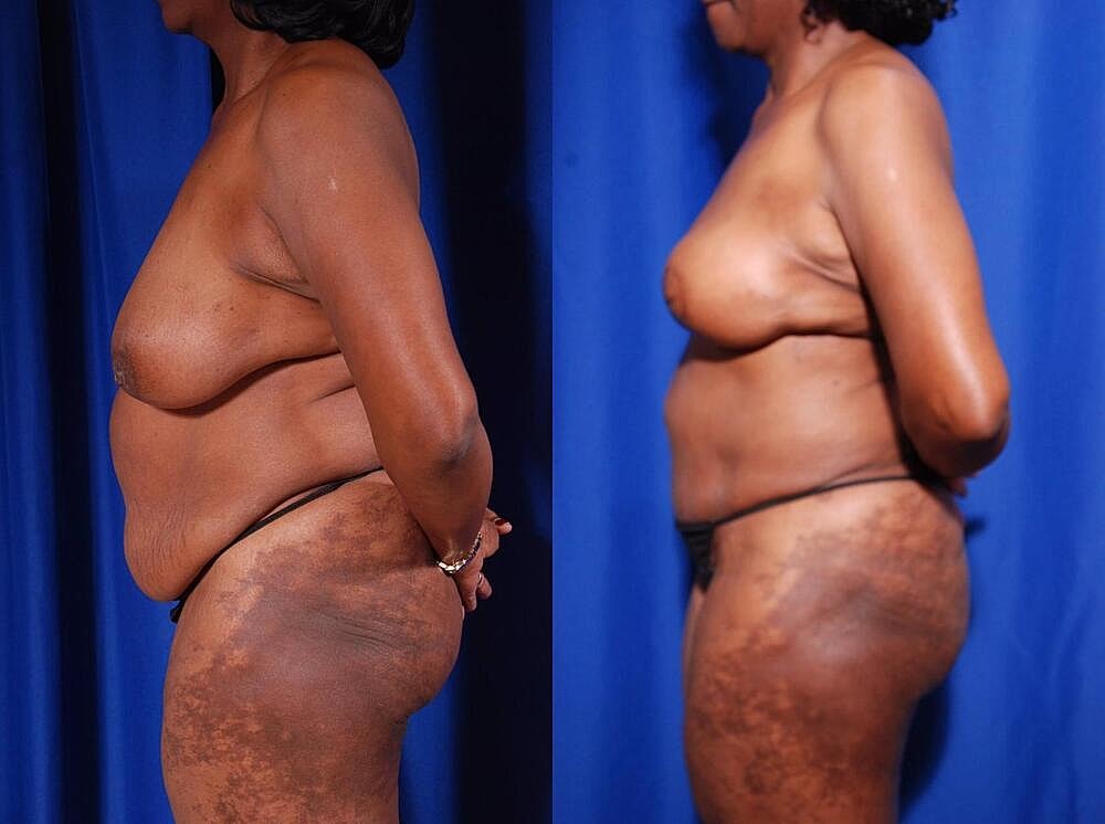 Fat Transfer Before & After