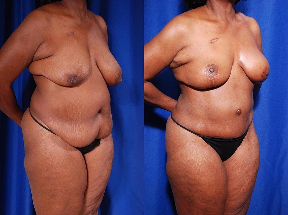 Fat Transfer Before & After