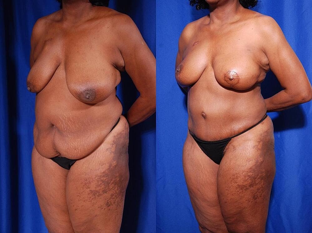 Fat Transfer Before & After