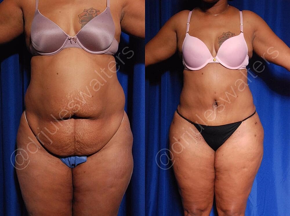 Fat Transfer Before & After