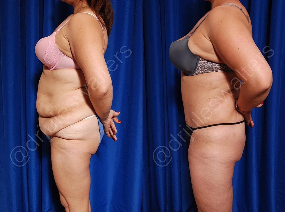 Fat Transfer Before & After