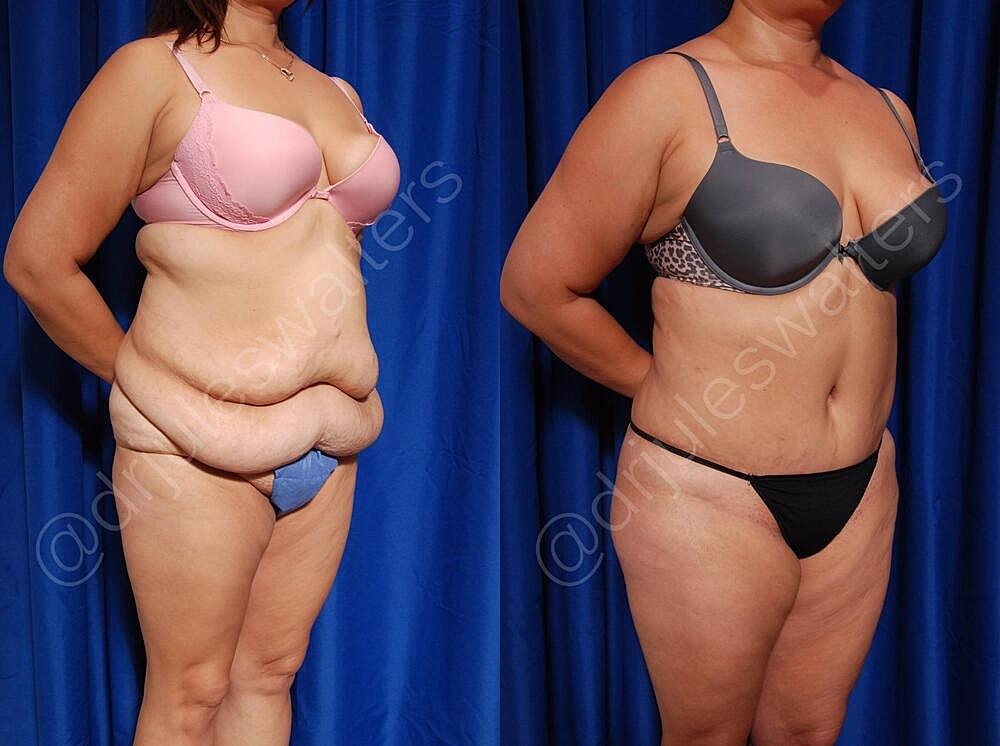 Fat Transfer Before & After