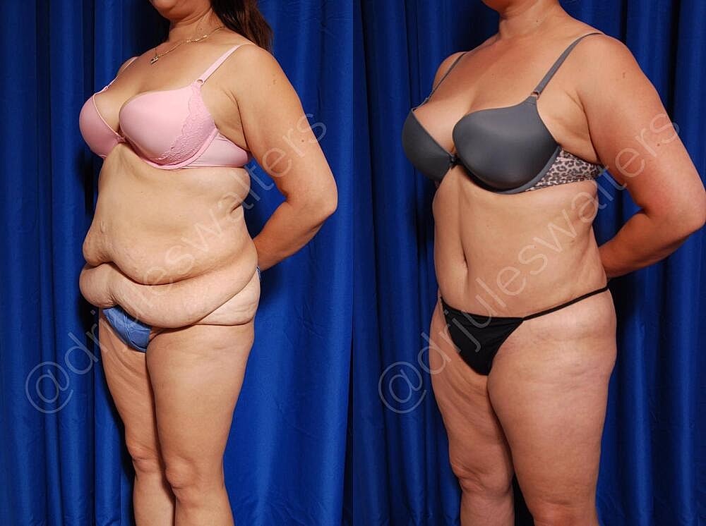 Fat Transfer Before & After
