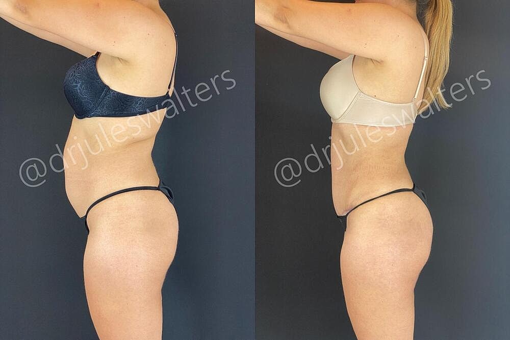 Fat Transfer Before & After