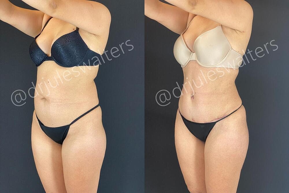 Fat Transfer Before & After