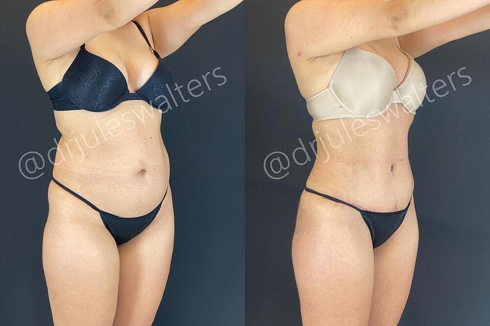 Fat Transfer Before & After