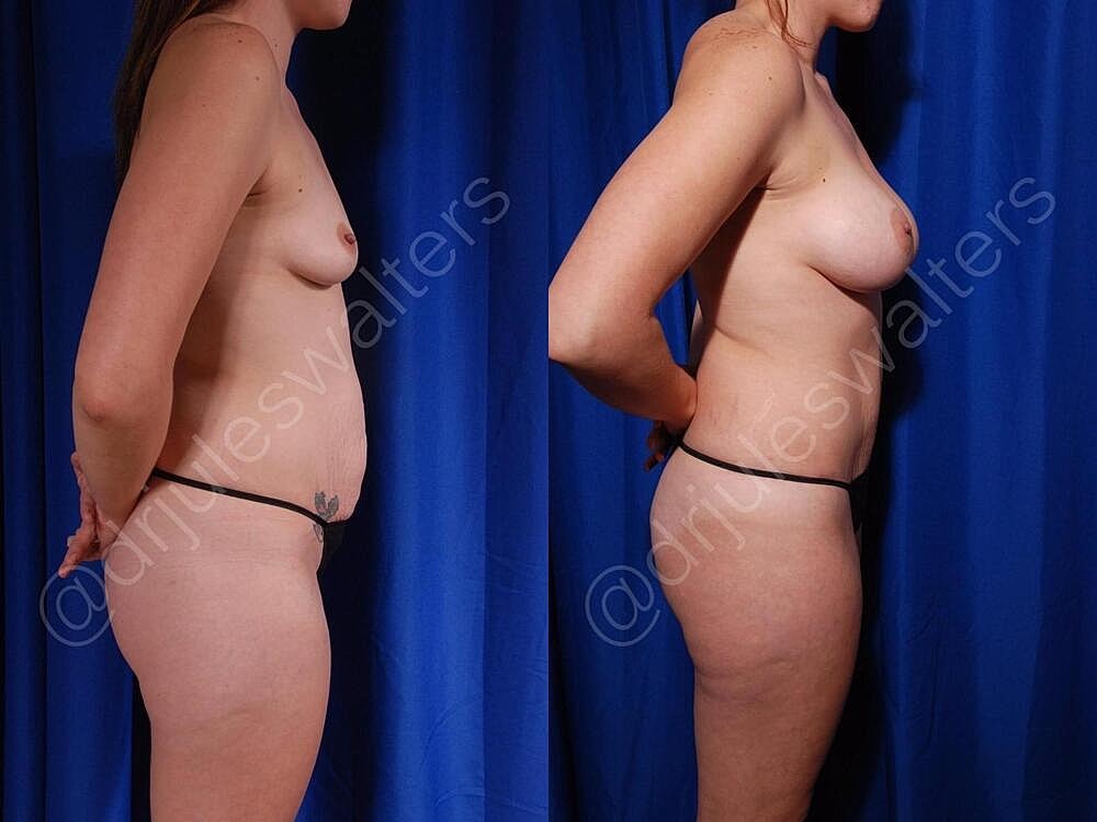 Fat Transfer Before & After