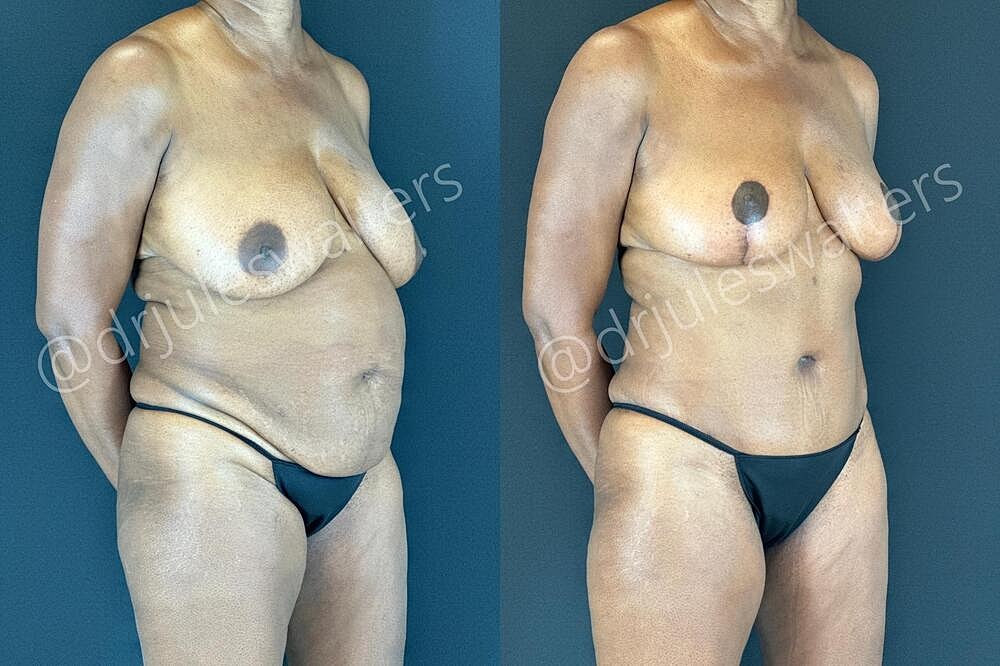 Fat Transfer Before & After