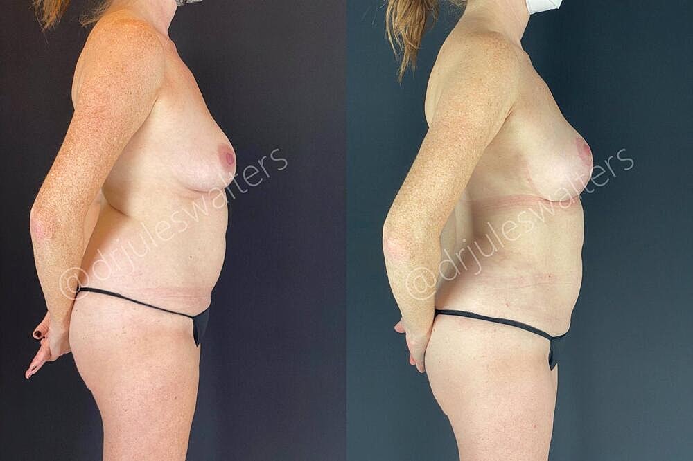Fat Transfer Before & After