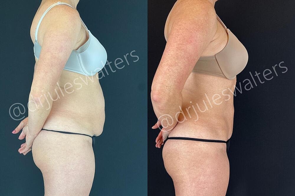 Fat Transfer Before & After