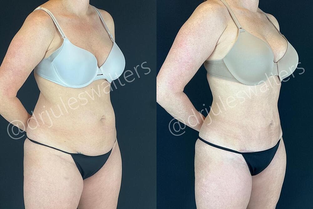 Fat Transfer Before & After