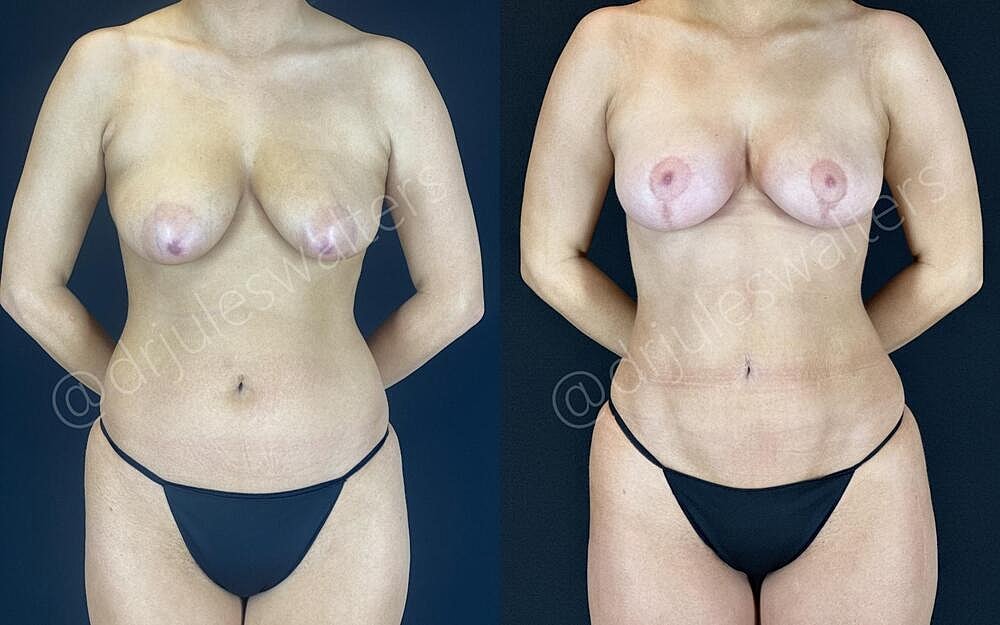 Fat Transfer Before & After