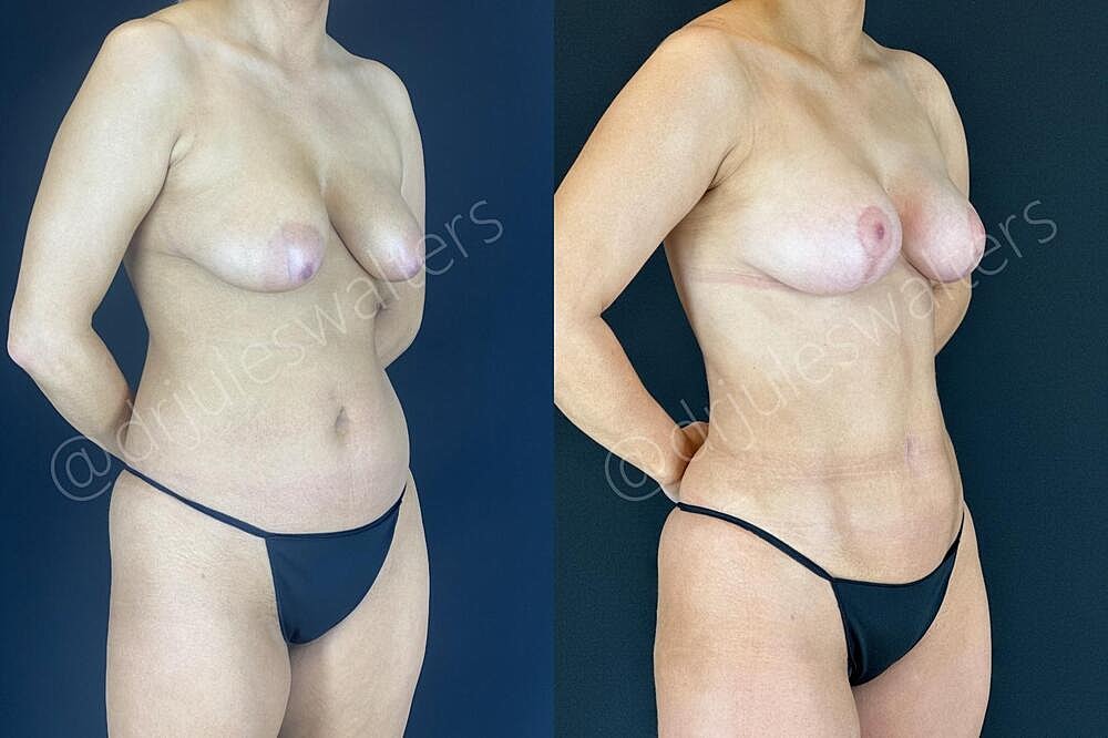 Fat Transfer Before & After