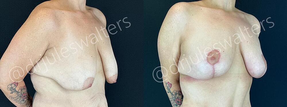 Fat Transfer Before & After