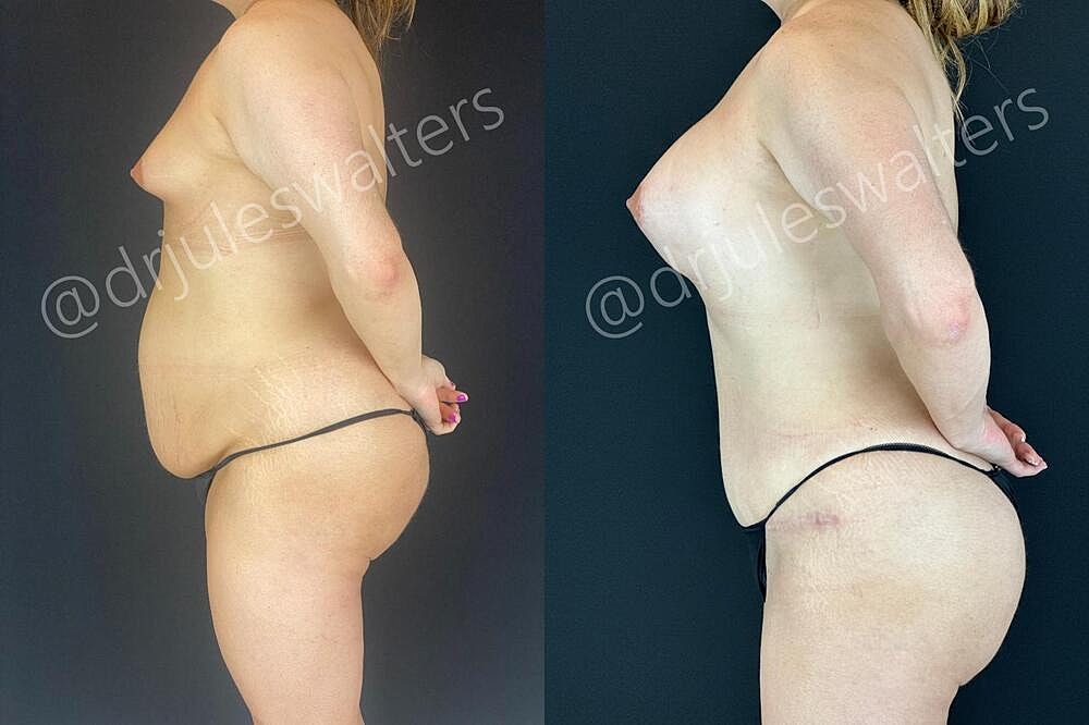 Fat Transfer Before & After