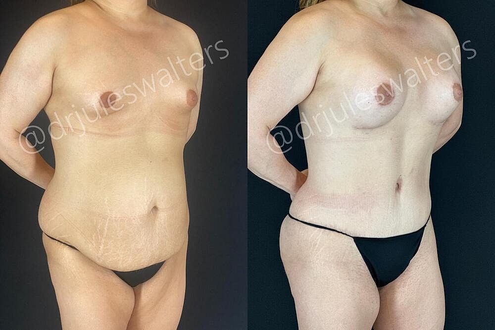 Fat Transfer Before & After